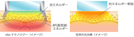 しみ対策